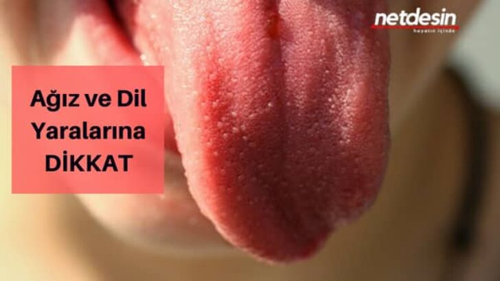 Ağız ve Dilde Oluşan Yara ve Çatlaklara Dikkat