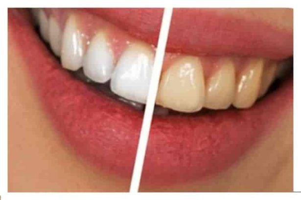 Evde dogal dis beyazlatma yontemleri