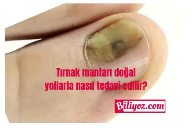 Tırnak mantarı tedavi yöntemleri