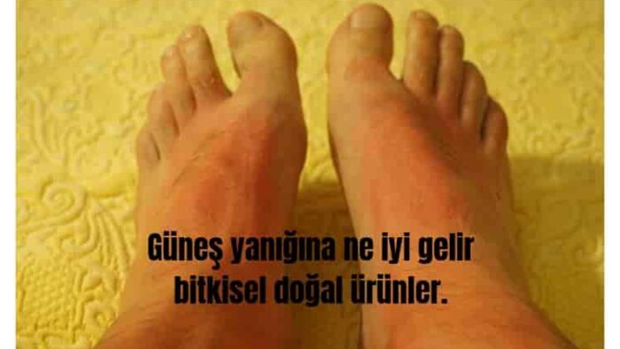 Güneş Yanığına Ne İyi Gelir? Bitkisel Doğal Ürünler.