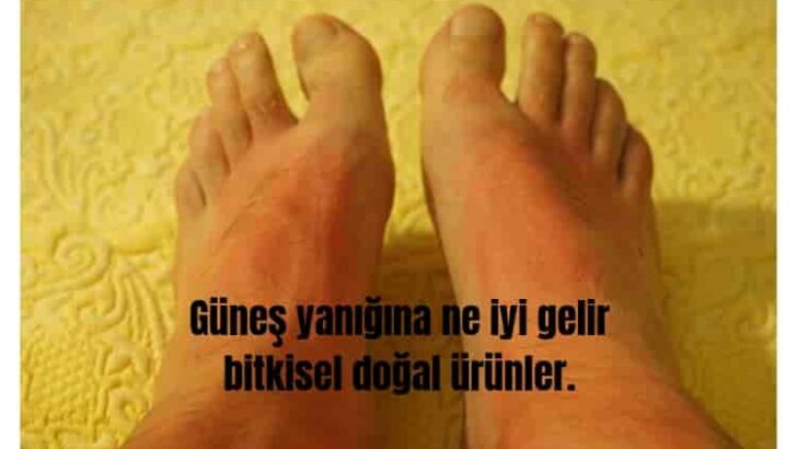 Güneş Yanığına Ne İyi Gelir? Bitkisel Doğal Ürünler.