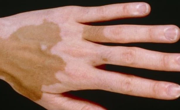 Addison hastalığı nedir