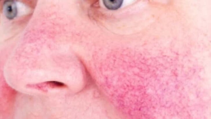 Rosacea Gül Hastalığı Nedir? Nasıl Tedavi Edilir?