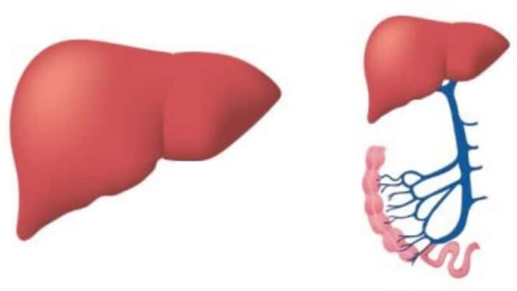 Karaciğer Yağlanması Nedir? Belirtileri Nelerdir?
