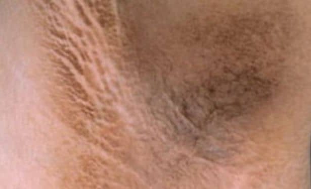 kol altı kararması