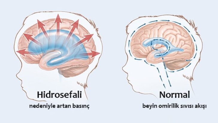 Hidrosefali Hastalığı Nedir? Genel Bilgiler