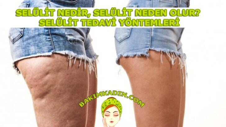 Selülit nedir, Selülit Neden Olur?