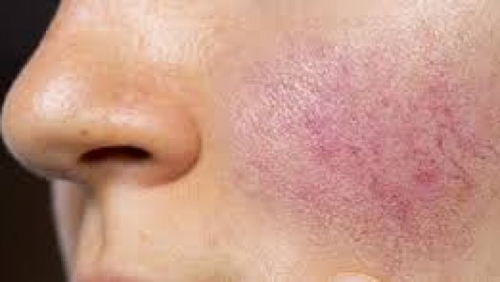 Rosacea (Kırmızı Yüz) Cilt Hastalığı Nedenleri