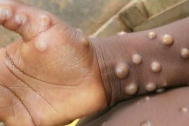 Maymun çiçeği virüsü